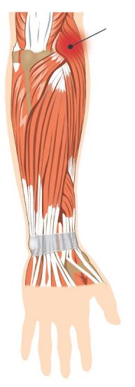 Epicondilita laterala - tennis elbow 