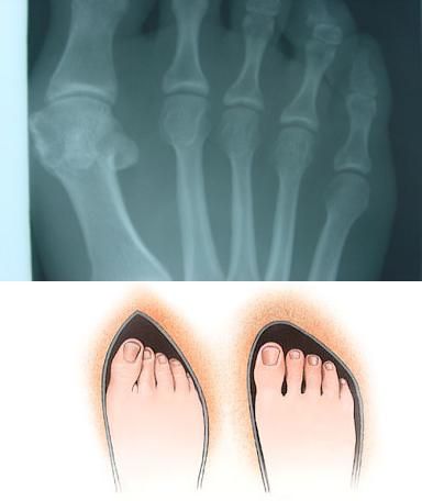 Hallux Valgus - Monturi