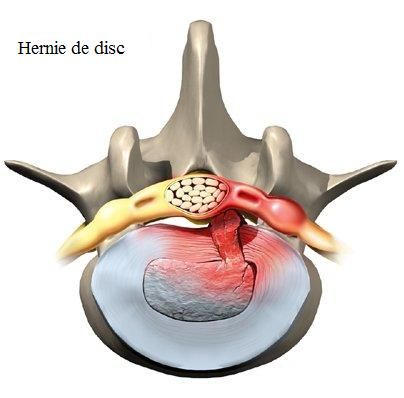 Hernie de disc