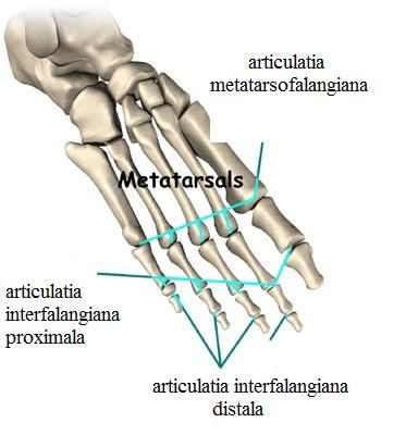 Leziune ,  fractura de metatarsian