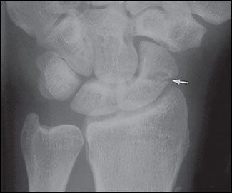 Leziune, fractura de scafoid