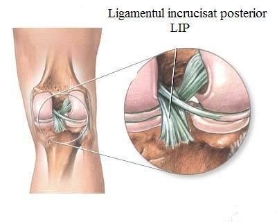 Ligamentul incrucisat posterior LIP