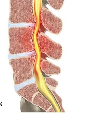 Lombosciatica