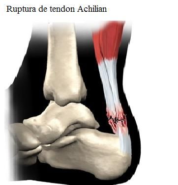 Ruptura la tendonul lui Achile
