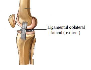 Ruptura , leziune de ligament colateral lateral ( extern )