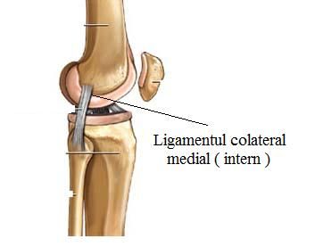 Ruptura , leziune de ligament colateral medial ( intern )