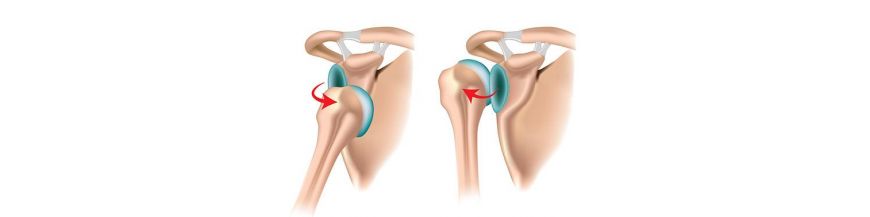 luxația tratamentului articulației umărului artroza ple tratament