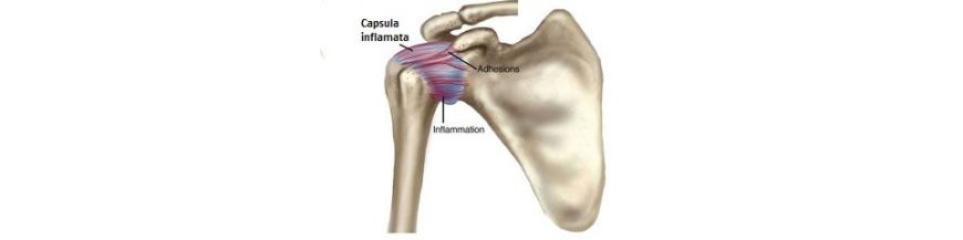 capsulita adezivă a articulației umărului cum se tratează)