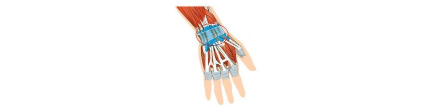 tratament de entorsă la încheietura mâinii articulațiile rănite de la saltea